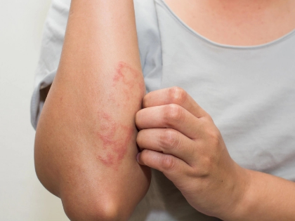 ¿¿ qué alergias causan picazón en la piel?